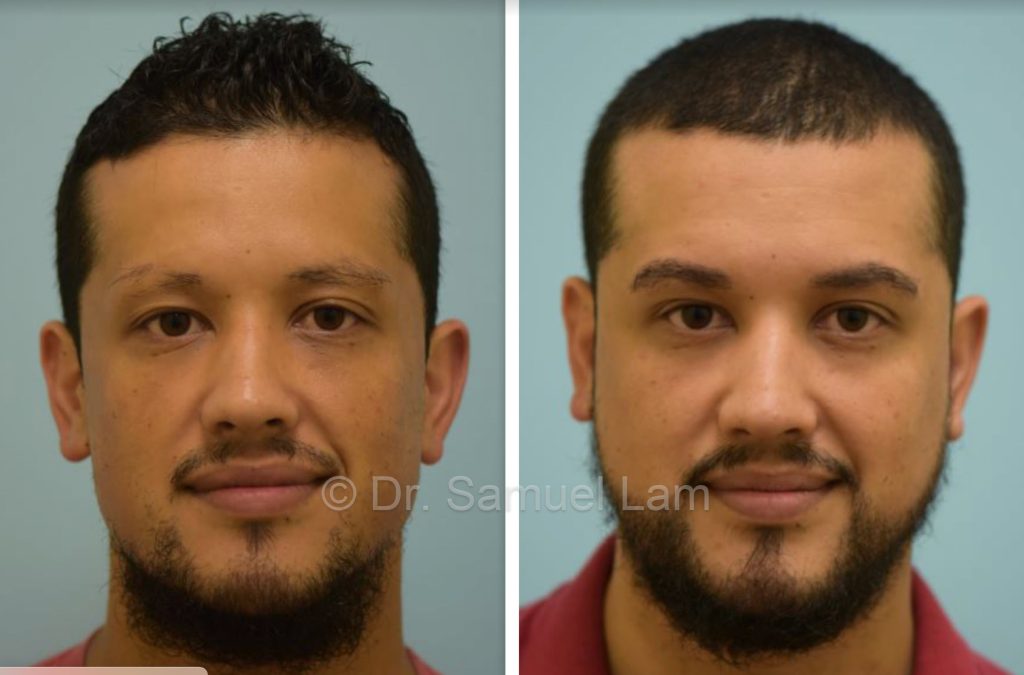 trasplante de barba antes y después de los resultados