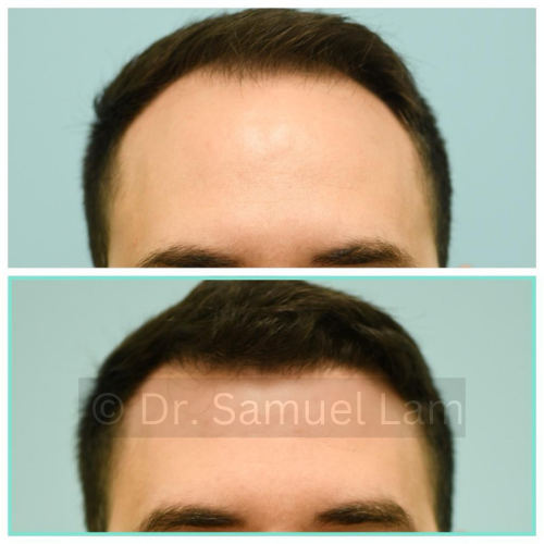 FUE antes y despu&eacute;s del lado frontal