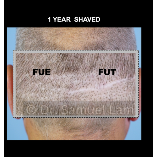 fue vs fut cicatrices afeitadas