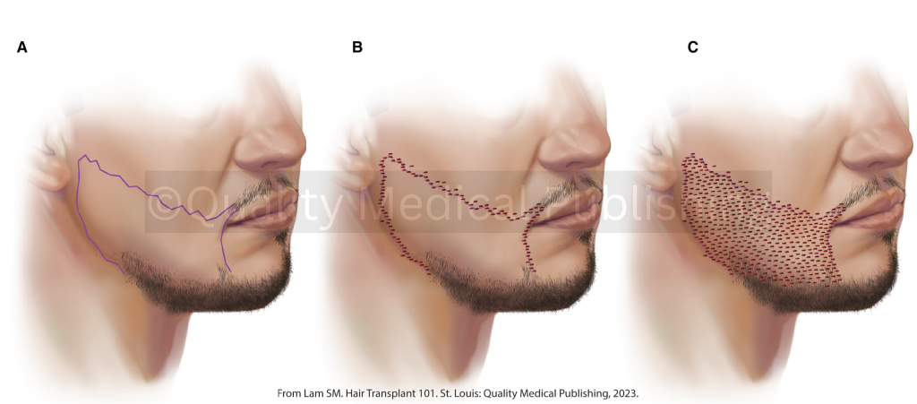 sitios receptores de pelo de la barba