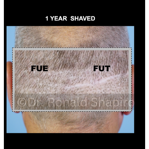 fue vs fut cicatrices afeitadas
