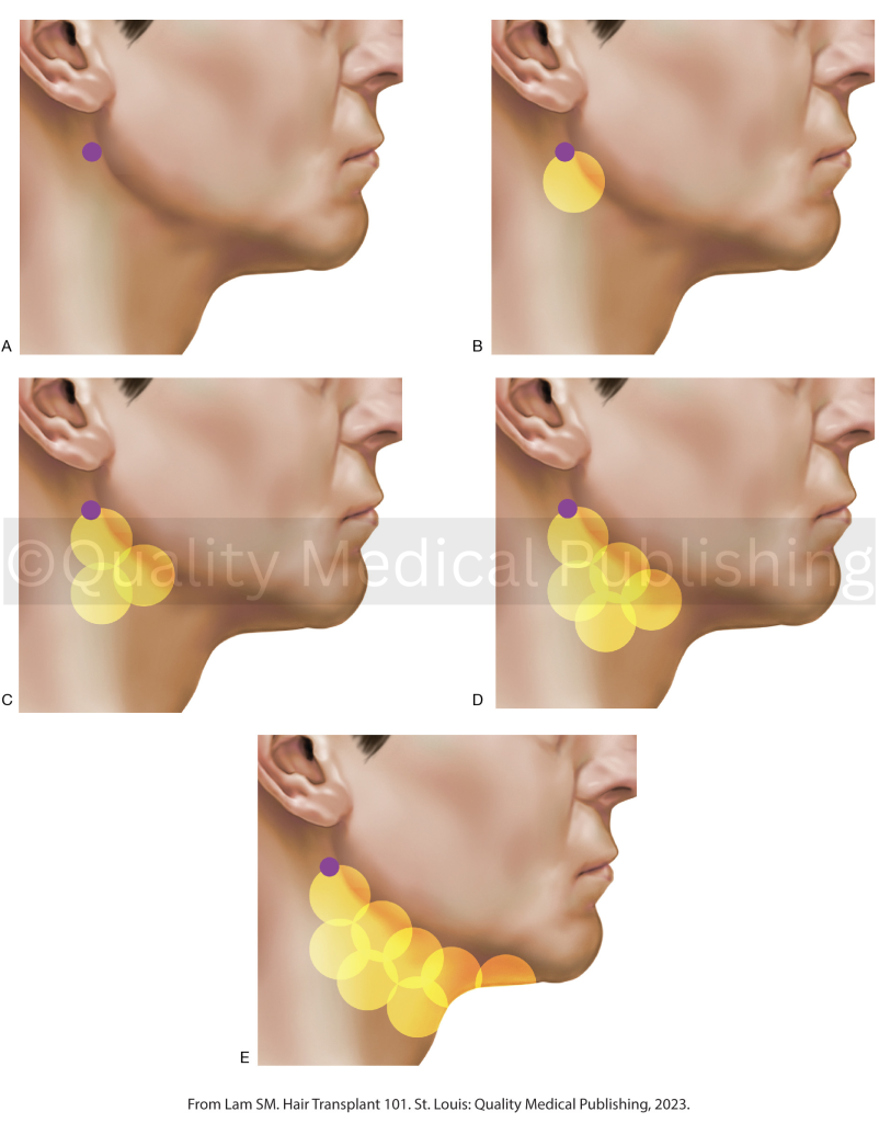 administración de anestesia en un trasplante de barba