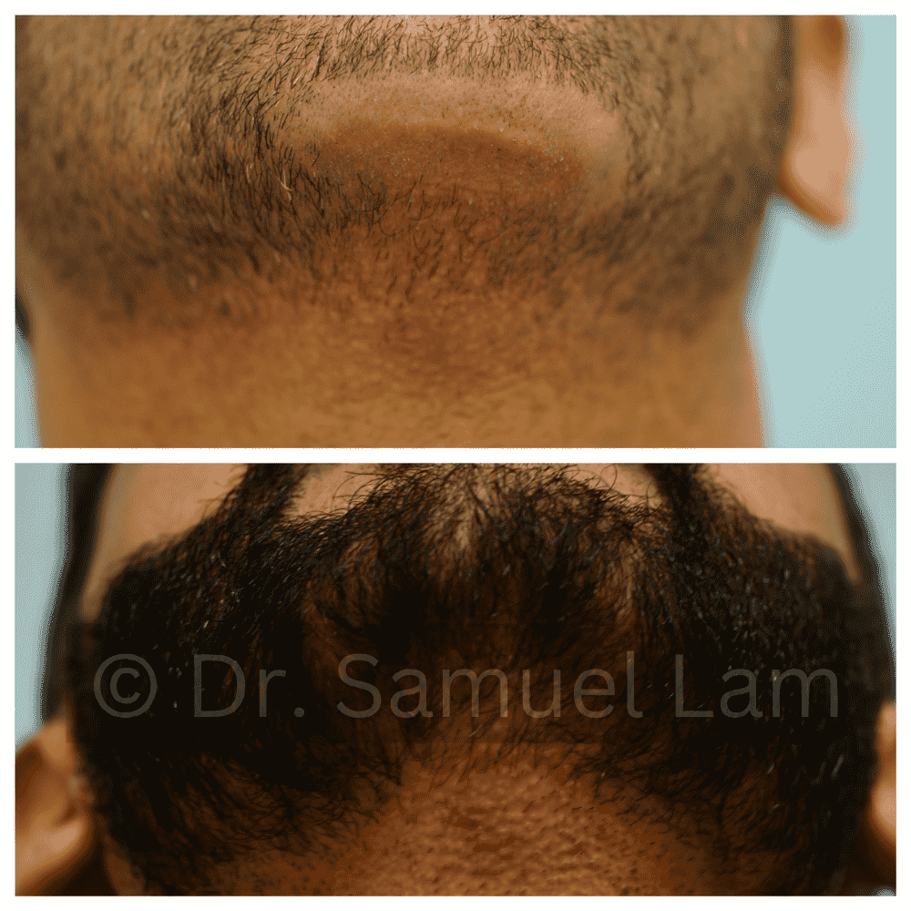 antes y después de la corrección de cicatrices en la barbilla