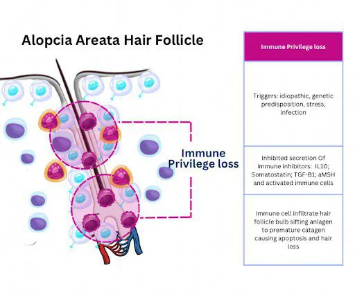 folículo piloso con alopecia areata