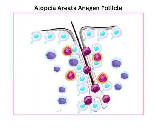 folículo anágeno con alopecia areata