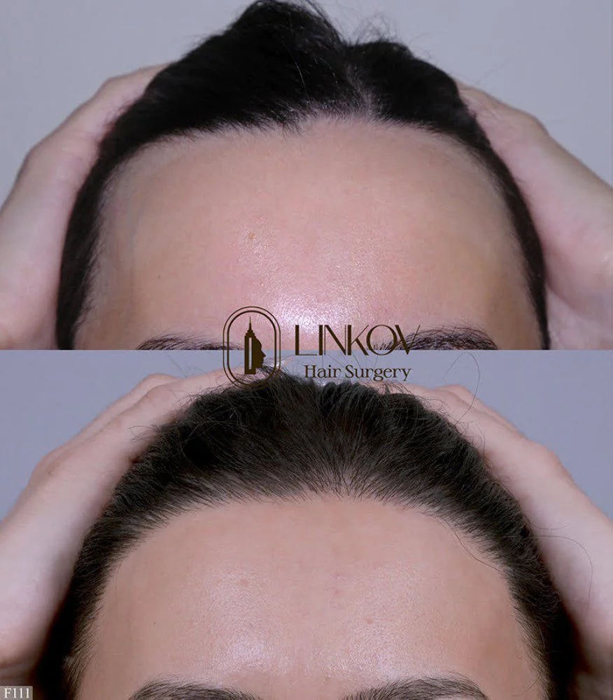 Before and after photos of a female after a hair transplant.