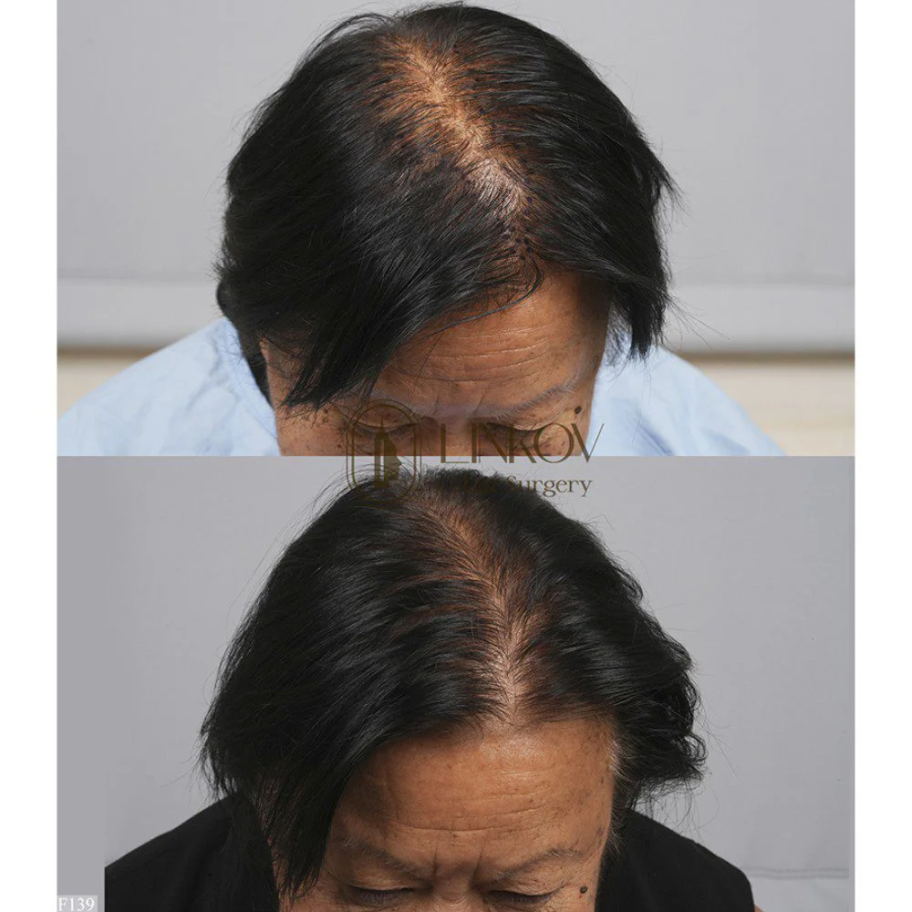 Before and after photos of an ethnic female after a hair transplant.