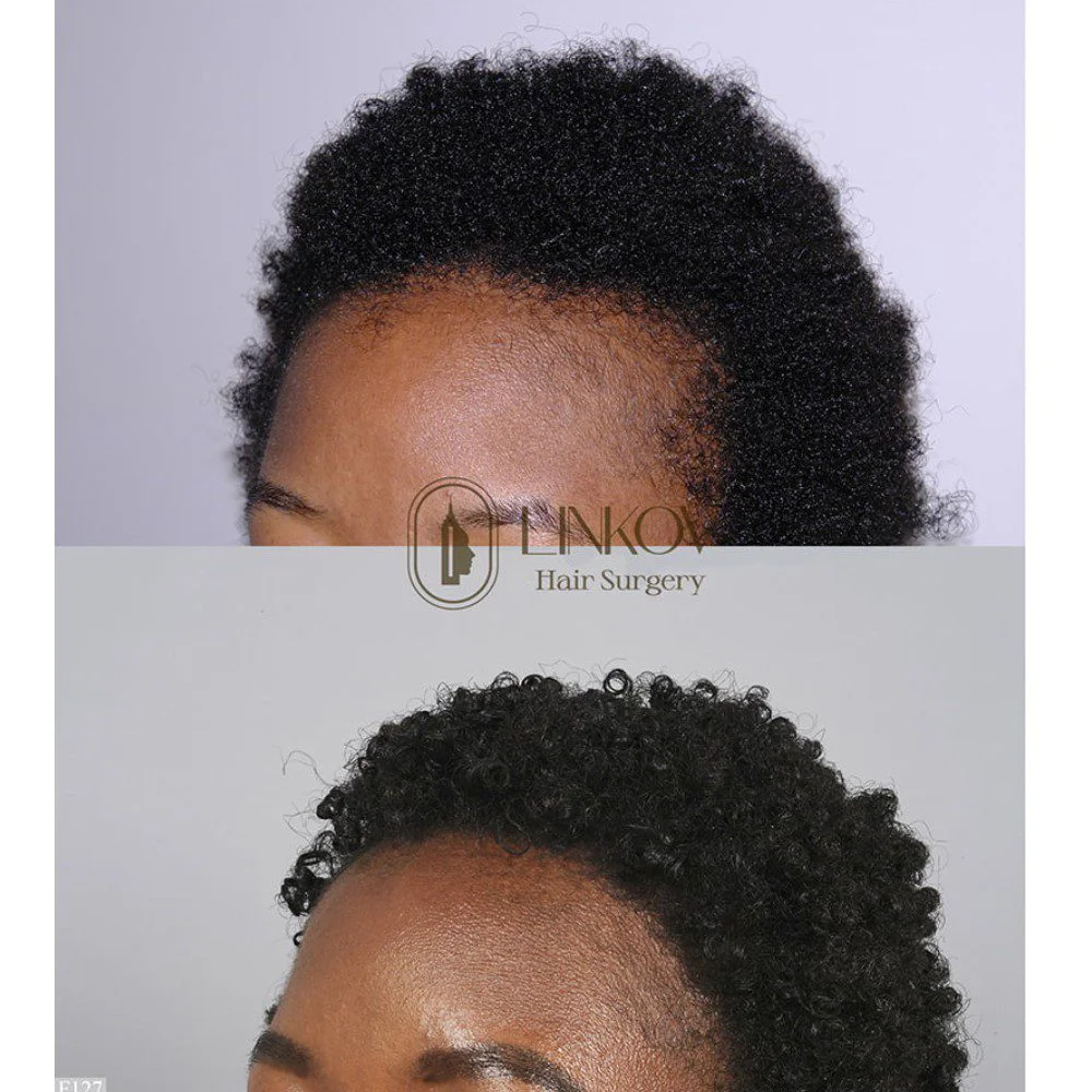 Before and after photos of a female with curly hair after a hair transplant.
