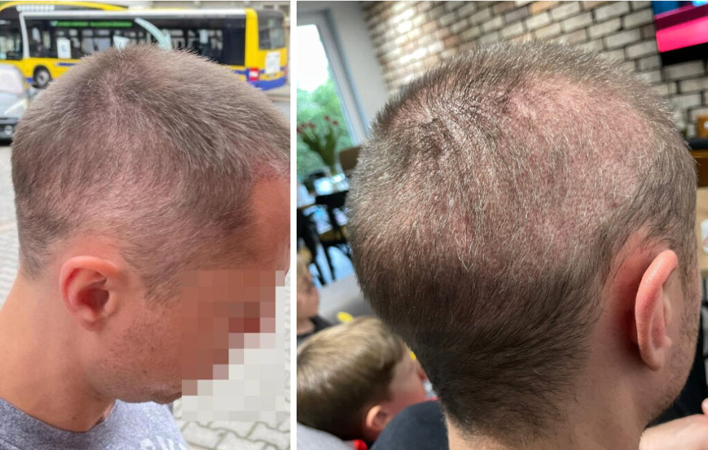 5 meses después del trasplante capilar cabello sobreexplotado