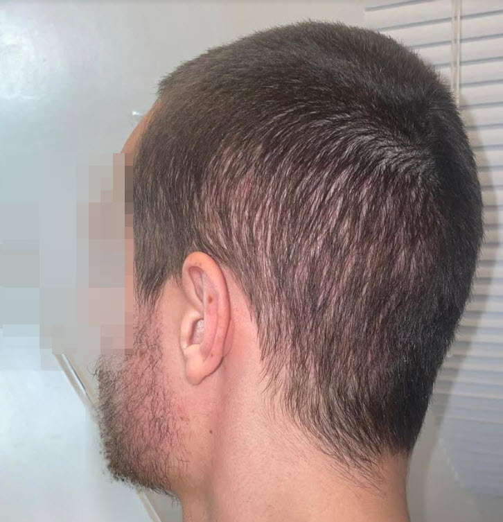 Clínica de trasplante de cabello en el mercado negro 1
