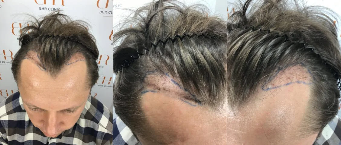 14 meses después de la reparación del trasplante capilar