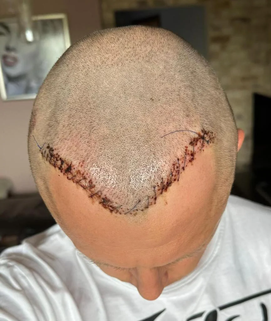 después de la reparación del trasplante capilar